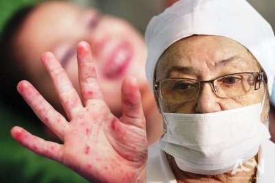 С начала года на Украине корью заболели почти 50 тысяч человек - «Новороссия»