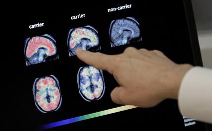 Альцгеймер, изыди! Китайцы нашли лекарство от главной болезни старости - «Мир»